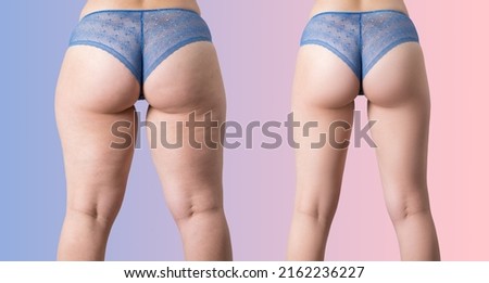Overweight woman with fat cellulite legs and buttocks, before after weight loss concept, obesity female body on purple pink gradient background