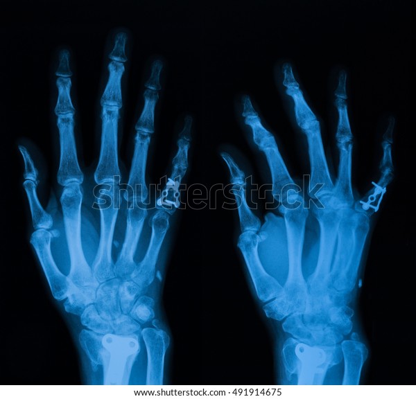 Pa Oblique Views Hand Include Wrist Stock Photo (Edit Now) 491914675