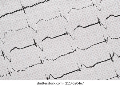 Pacemaker ECG With Ventricular Stimulation 