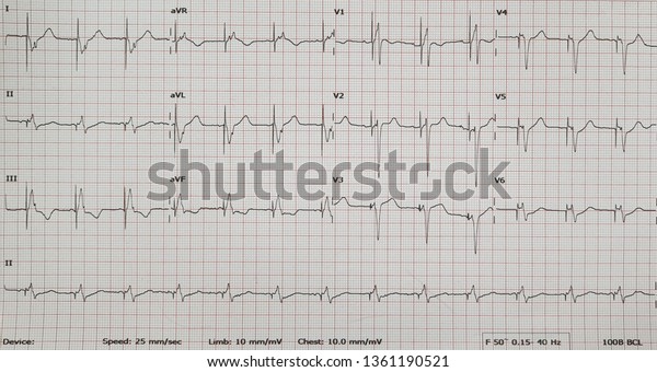 Pacing Ecg Pace V Pace Cardiac Stock Photo 1361190521 | Shutterstock