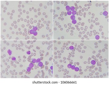 Blood Smear Show Acute Myelocytosis Leukemia Stock Photo 110012570 ...