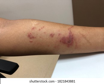 Paederus Dermatitis (Irritant Contact Dermatitis)