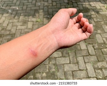 Paederus Dermatitis or 'tomcat' insect wound on left hand. Irritated skin.