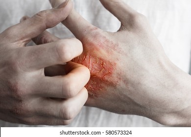 Pain Red Spot On Man Hand With Eczema Rash Or Allergy. Conceptual Photo About Healtcare And Skin Problems. Atopic Psoriasis Close Up Skin.