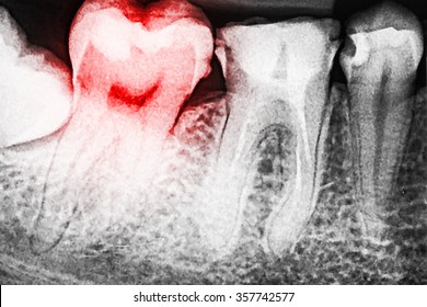 Pain Of Tooth Decay On Teeth X-Ray