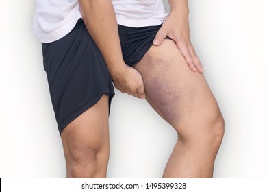 Pain In The Upper Thigh After Playing Sports On White Background .thigh Muscle Ligament Injury Risk Factors.Bruises On Skin Leg