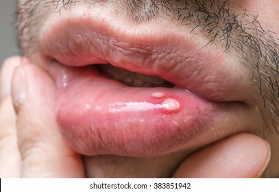 Painful Aphtha Ulcer On Man's Mouth.