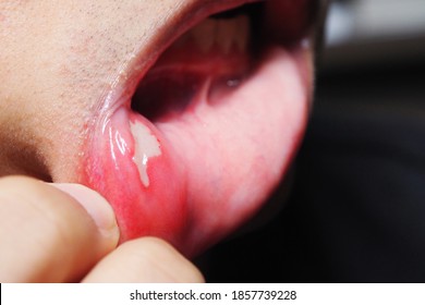 Painful Aphthous Ulcer with white or grey film inside of the human mouth from cut or bite while eating food and other injuries - Shutterstock ID 1857739228