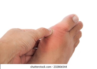 Painful Gout Inflammation On Big Toe Joint