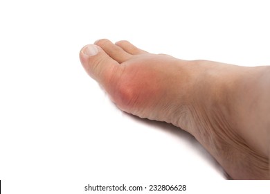 Painful Gout Inflammation On Big Toe Joint