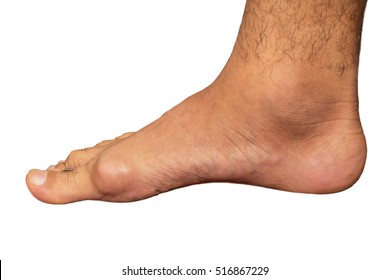 Painful Gout Inflammation On Big Toe Joint On White Background.