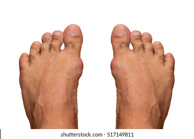 Painful Gout Inflammation On Big Toe Joint On White Background.