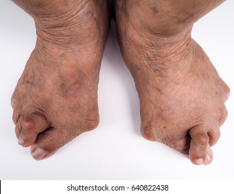 Painful Gout Inflammation On Big Toe Joint On White Background, The Old Man Is Gout At Finger Of Foot As A Result Foot Deformities