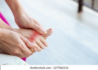 Painful and inflamed gout on foot 