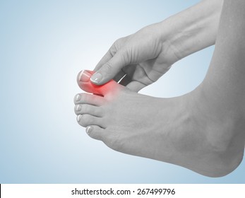 Painful And Inflamed Gout On His Foot Around The Big Toe Area.