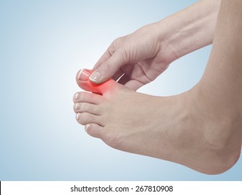Painful and inflamed gout on his foot around the big toe area.