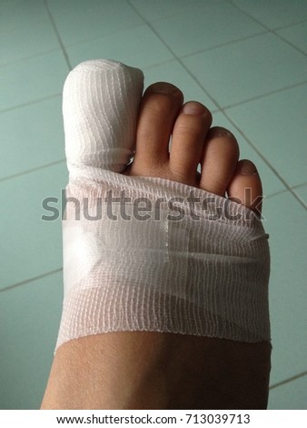 Painful toe for losing the nail