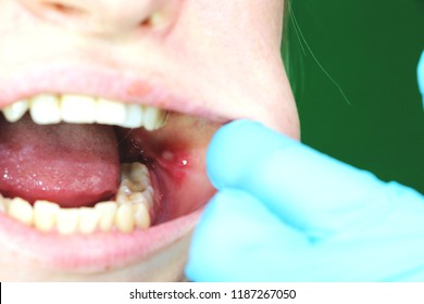 Aphthous Ulcer Images Stock Photos Vectors Shutterstock