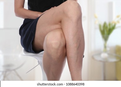 Painful Varicose And Spider Veins On Female Legs.