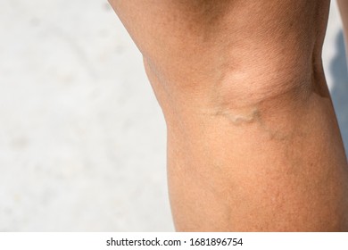 Painful varicose and spider veins on womans legsใ