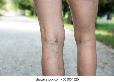 Painful varicose and spider veins on womans legs, who is active and working out, self-helping herself in overcoming the pain. Vascular disease, varicose veins problems, active life concept. 