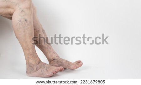 Painful varicose veins and spider veins on active women's legs, helping oneself to overcome pain. Vascular disease, varicose vein problems, White background.