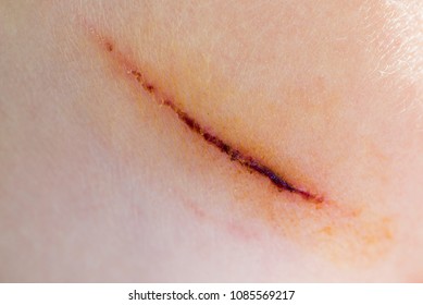 Painful wound from deep cut