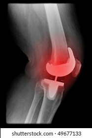 Painfull Knee Joint Replacement Isolated On Black Background