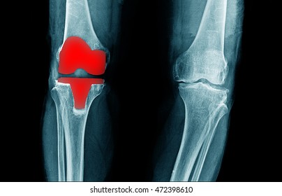 Painfull Knee Joint Replacement On Black Background