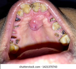 A Painless Benign Growth Called Palatal Torus In The Midline Of Hard Palate And Broken And Stained Teeth With Caries In The Oral Cavity Of Southeast Asian Elder Woman. Unhealthy Teeth.