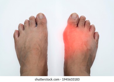 Pair of feet with deformed right toe due to painful gout inflammation, painful and inflamed gout on his foot around the big toe area.