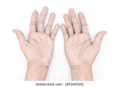 Pale Palmar Surface Of Both Hands. Anaemic Hands Of Asian, Chinese Man. Isolated On White Background.