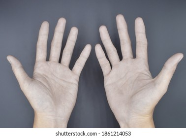 Pale Palmar Surface Both Hands Anaemic Stock Photo 1861214053 ...