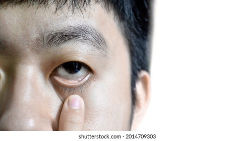 Pale Skin Of Asian Man. Sign Of Anemia. Pallor At Eyelid. Isolated On White.