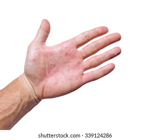 Palm Patient Erythema Red Ulcers Inflammation Stock Photo 341920658 ...