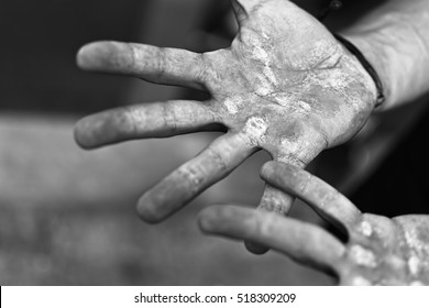 Palms with Calluses. Blisters on the Injured Hands From Manual Work. Hard Work Concept. - Shutterstock ID 518309209