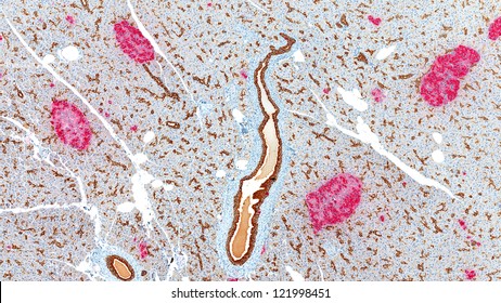 Pancreas stained for insulin (red) showing multiple islands of Langerhans containing beta cells stained immunohistochemically for insulin (red island) with ducts stained for cytokeratin (Brown)