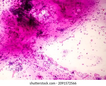 Pancreatic mass(CT Guided FNA): Positive malignant cell, adenocarcinoma, atypical epithelial cells, pleomorphism with prominent nuclei and cytoplasm, chronic inflammatory cells. - Shutterstock ID 2091572566