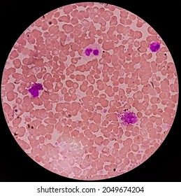 Pancytosis, Blood Smear Showing Clumps Or High Volume Of Platelet And White Blood Cell And Red Blood Cell, Analyze By Microscope.