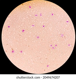 Pancytosis, Blood Smear Showing Clumps Or High Volume Of Platelet And White Blood Cell And Red Blood Cell, Analyze By Microscope.