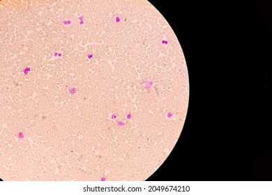 Pancytosis, Blood Smear Showing Clumps Or High Volume Of Platelet And White Blood Cell And Red Blood Cell, Analyze By Microscope.