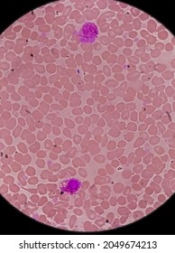 Pancytosis, Blood Smear Showing Clumps Or High Volume Of Platelet And White Blood Cell And Red Blood Cell, Analyze By Microscope.