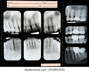 A panel of nine dental x-rays, brightly showing crowns, root canals, and fillings where cavities and decay had been found. - Powered by Shutterstock