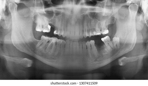 Opg Orthopantomography Dental Xray Tooth Stock Photo 1741413365 ...