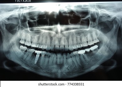 Panoramic Dental X Ray With Implant