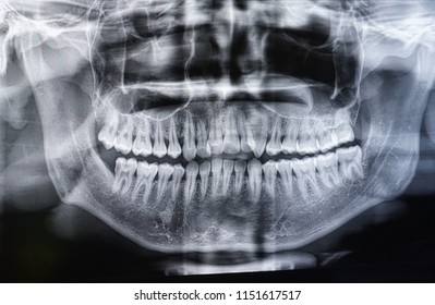 Panoramic dental X-Ray
                               