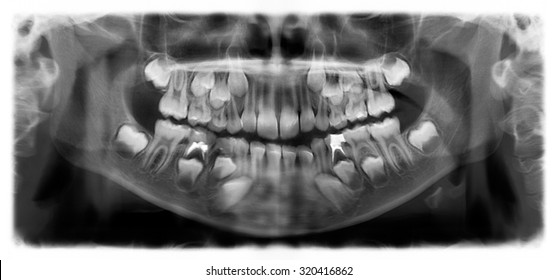 Panoramic dental x-ray of child of seven (7) years. Black and white image roentgen teeth upper and lower jaw skull of girl. Negative shot of the digital picture