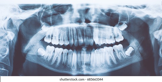 Panoramic Dental X-ray Of Child/toned Photo