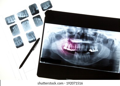 Panoramic Dental X-Ray For Dentist And Dental Care In Computer Screen And Film 