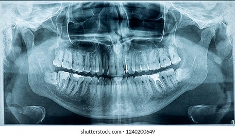Panoramic dental x-ray film, Problem with wisdom teeth and tooth filling. - Shutterstock ID 1240200649
